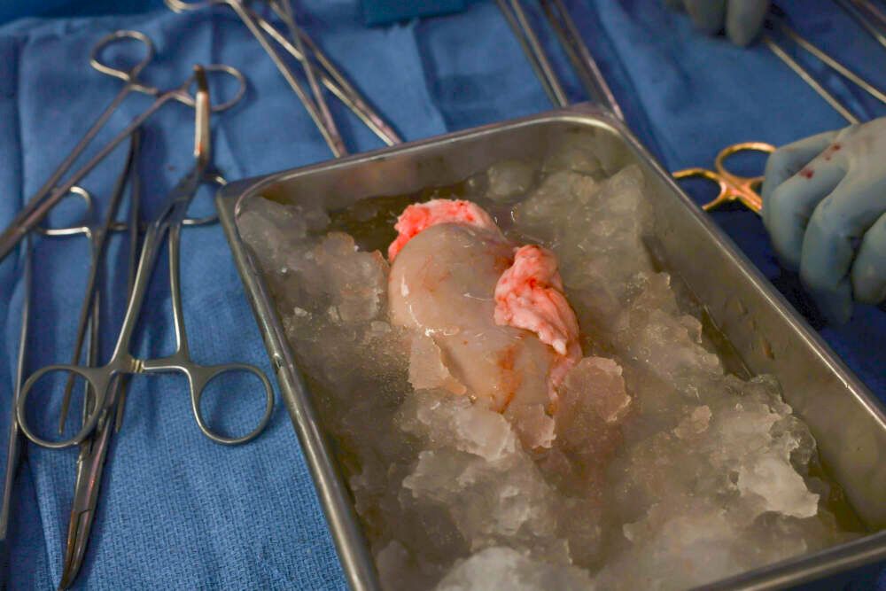 Per la prima volta, un rene di maiale è stato trapiantato in un paziente umano vivente.